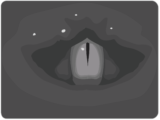 Vocal Cords